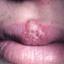 22. Herpes on Lip Pictures
