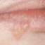 23. Herpes on Lip Pictures