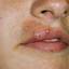 24. Herpes on Lip Pictures