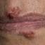 25. Herpes on Lip Pictures
