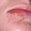 3. Herpes on Lip Pictures