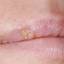 6. Herpes on Lip Pictures