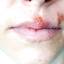 7. Herpes on Lip Pictures