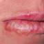 9. Herpes on Lip Pictures