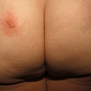 Herpes on Buttocks