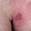 11. Herpes on Buttocks Pictures