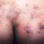 25. Herpes on Buttocks Pictures
