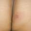 3. Herpes on Buttocks Pictures