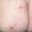 4. Herpes on Buttocks Pictures