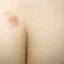 5. Herpes on Buttocks Pictures