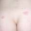 7. Herpes on Buttocks Pictures