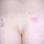 9. Herpes on Buttocks Pictures