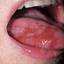 1. Herpes on Tongue Pictures