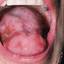 3. Herpes on Tongue Pictures