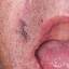 5. Herpes on Tongue Pictures