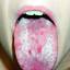 8. Herpes on Tongue Pictures