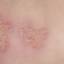 16. What is Herpes Pictures