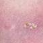 2. What is Herpes Pictures