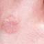 23. What is Herpes Pictures