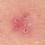 5. What is Herpes Pictures