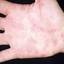4. Herpes on Palms Pictures