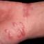 8. Herpes on Palms Pictures