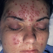Herpes on Face