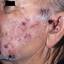 27. Herpes on Face Pictures