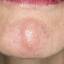 7. Herpes on Face Pictures