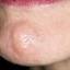 8. Herpes on Face Pictures