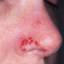 1. Herpes on Nose Pictures