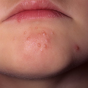 Herpes on Chin