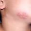 1. Herpes on Chin Pictures