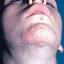 3. Herpes on Chin Pictures