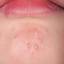 4. Herpes on Chin Pictures