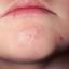 5. Herpes on Chin Pictures