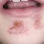 6. Herpes on Chin Pictures