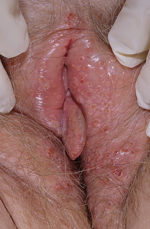 areas.Herpes simplex virus (HSV) is the cause of genital herpes.Genital her...