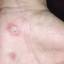 1. Herpes on Hands Pictures