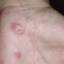 2. Herpes on Hands Pictures