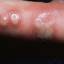 24. Herpes on Hands Pictures
