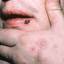 28. Herpes on Hands Pictures