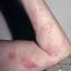 41. Herpes on Hands Pictures