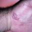 42. Herpes on Hands Pictures