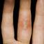 7. Herpes on Hands Pictures