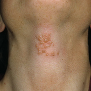 Herpes on Neck