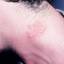 2. Herpes on Neck Pictures