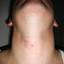 5. Herpes on Neck Pictures