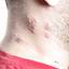 6. Herpes on Neck Pictures