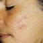 10. Herpes on Cheek Pictures